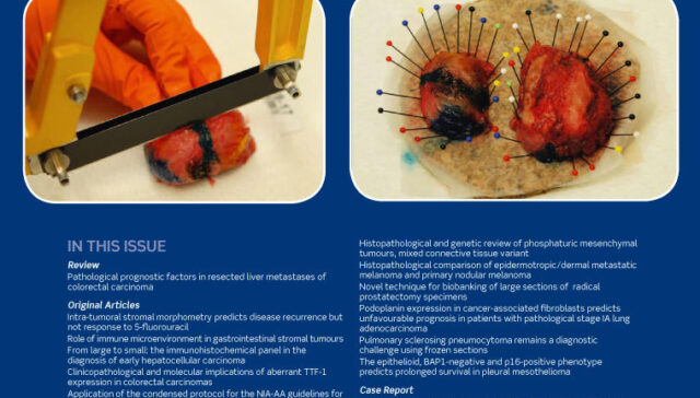 Role of immune microenvironment in gastrointestinal stromal tumours